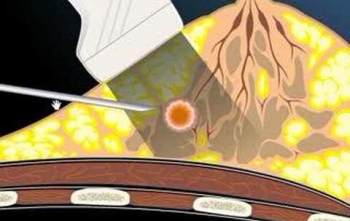 Dez fatos sobre a Biópsia